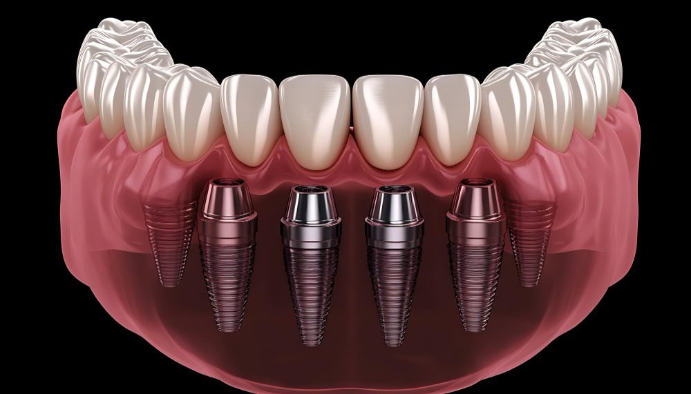 افضل عيادة لزراعة الأسنان بتقنية All-on-4 في سوريا