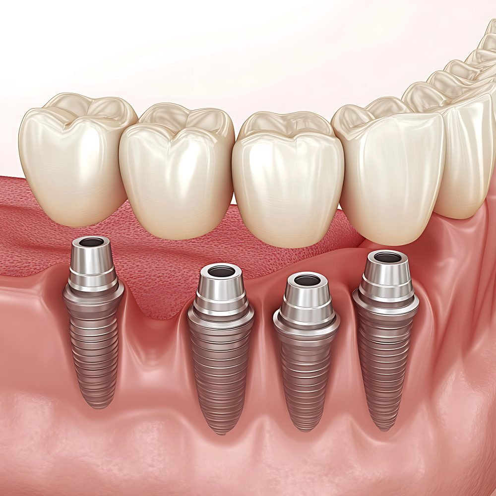 زراعة الأسنان بتقنية All-on-4 في سورية حلب